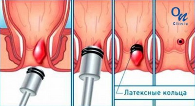 Лечить геморрой в Усть-каменогорске